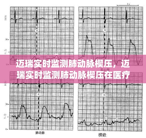 迈瑞实时监测肺动脉楔压，医疗领域的应用与前景分析